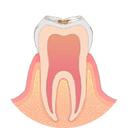 歯の表面に虫歯ができます