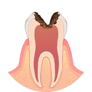 熱いものがしみて、ズキズキ痛みます