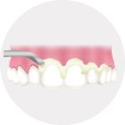 フッ化物入りペーストを塗布